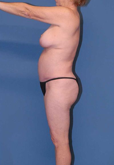 Liposuction Before & After