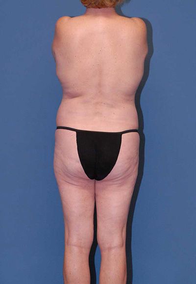 Liposuction Before & After