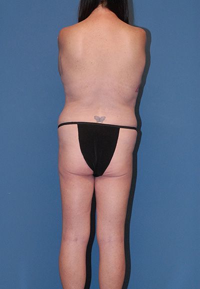 Liposuction Before & After
