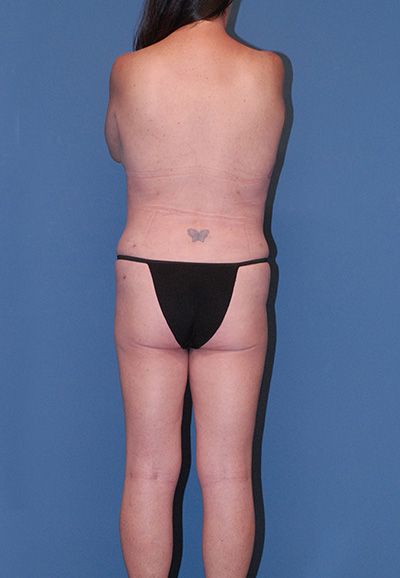 Liposuction Before & After