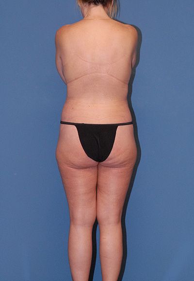 Liposuction Before & After