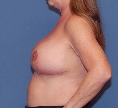 Liposuction Before & After