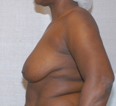 Liposuction Before & After