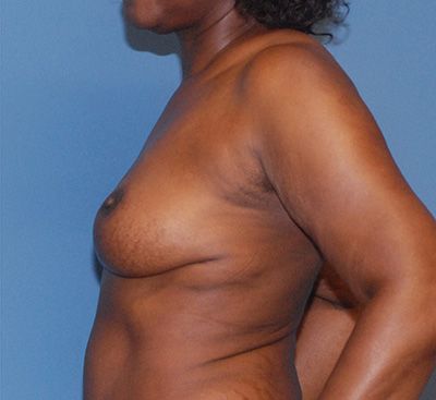 Liposuction Before & After