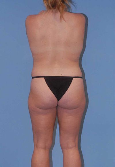 Liposuction Before & After