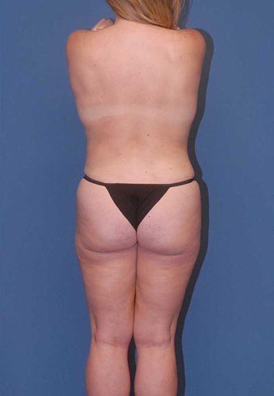Liposuction Before & After