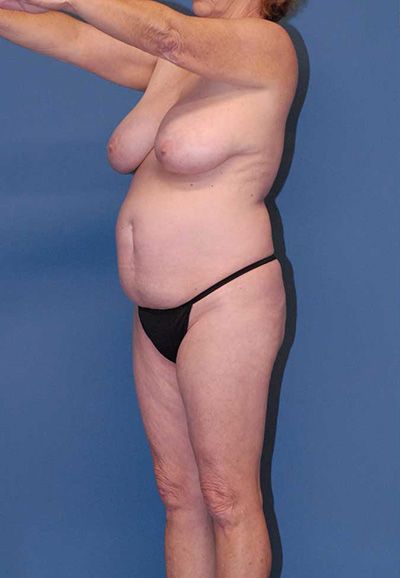 Liposuction Before & After