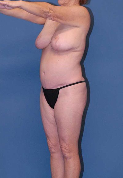 Liposuction Before & After