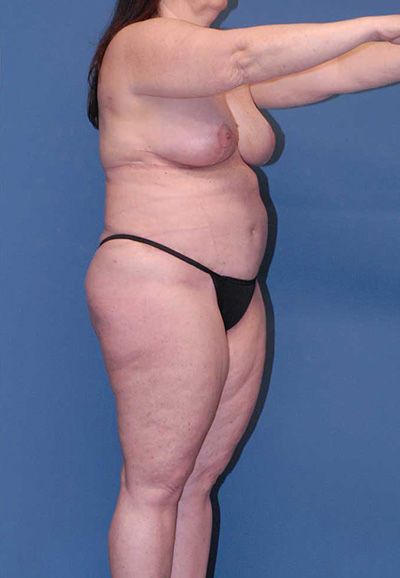 Liposuction Before & After