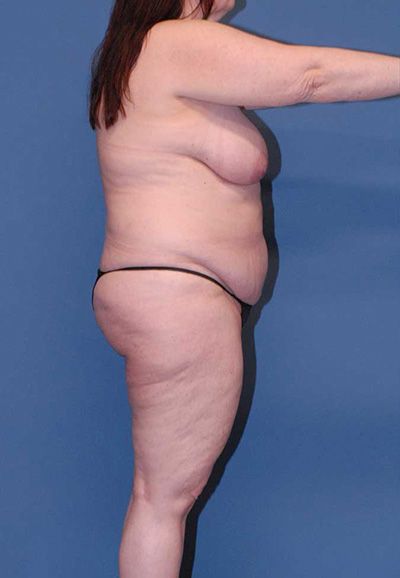 Liposuction Before & After