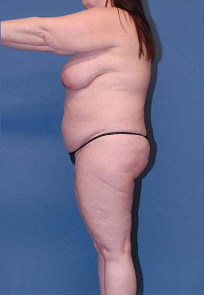 Liposuction Before & After