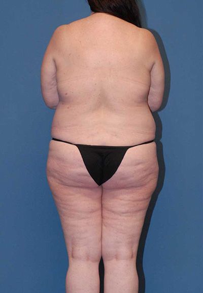 Liposuction Before & After