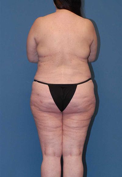 Liposuction Before & After