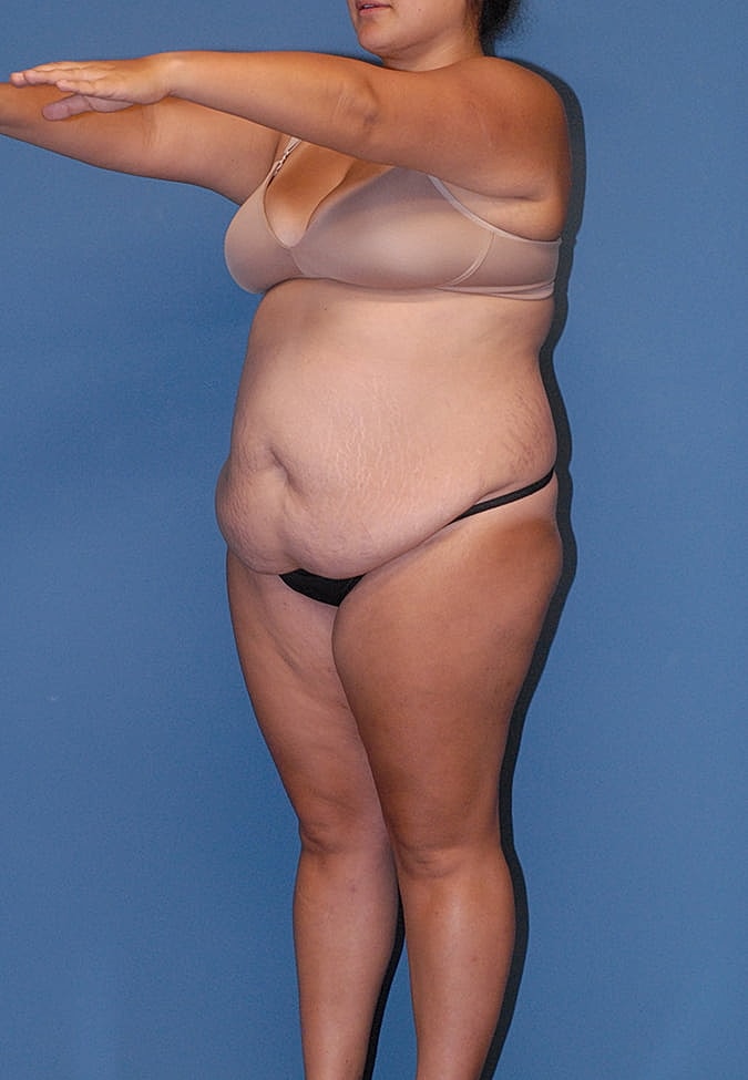 Liposuction Before & After