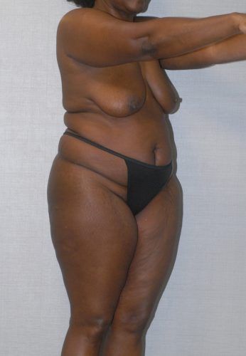Liposuction Before & After