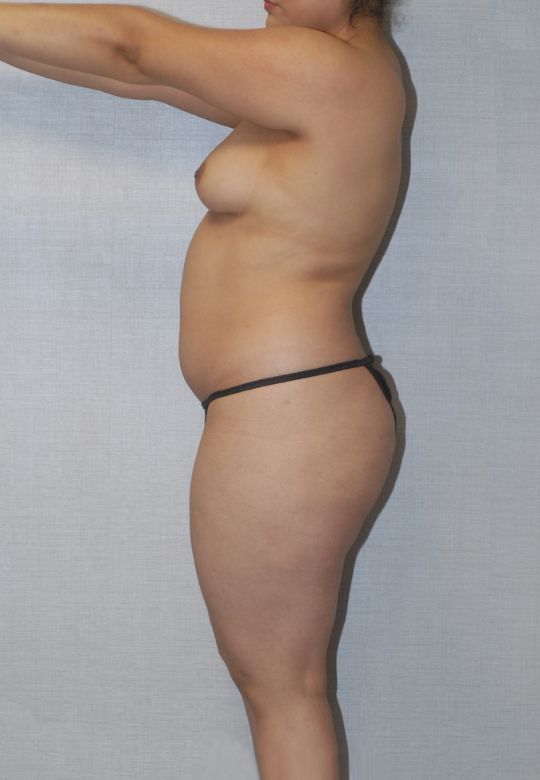 Liposuction Before & After