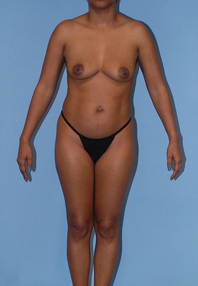 Motiva Breast Implants Before & After