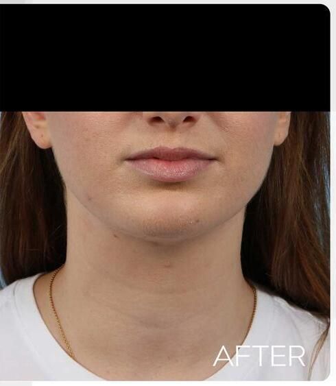 Chin Implants Before & After