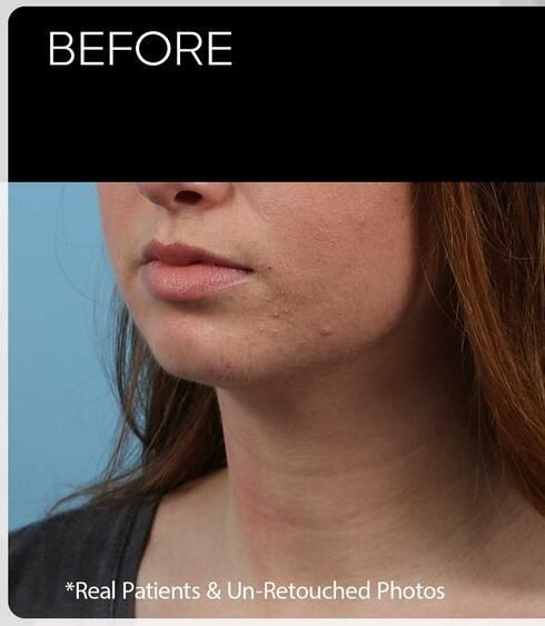 Chin Implants Before & After