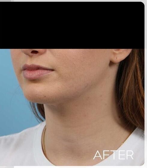 Chin Implants Before & After