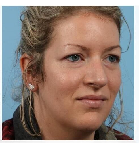 Rhinoplasty Before & After