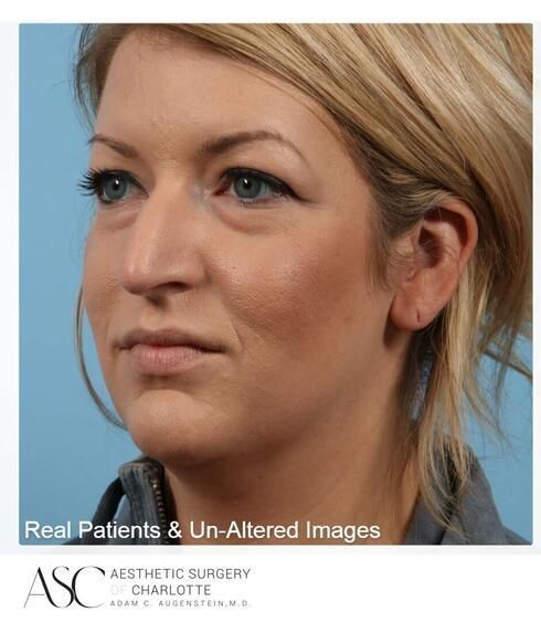 Rhinoplasty Before & After