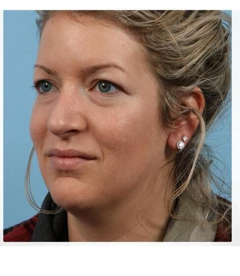 Rhinoplasty Before & After