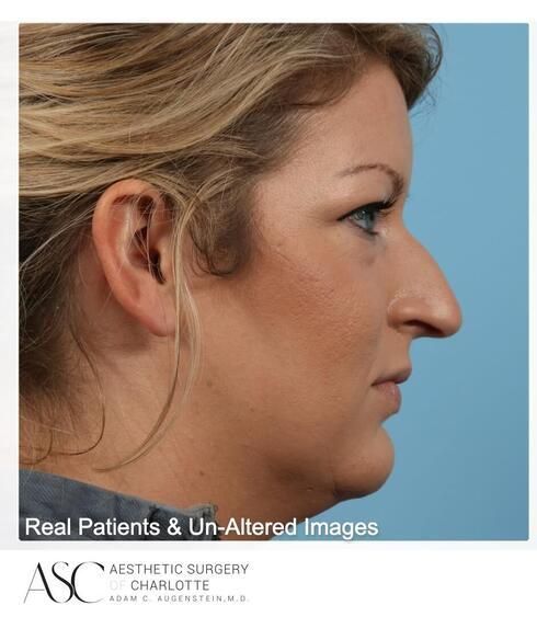 Rhinoplasty Before & After