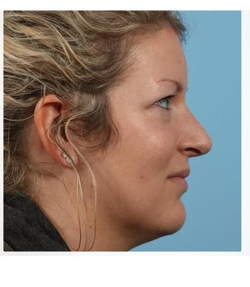 Rhinoplasty Before & After