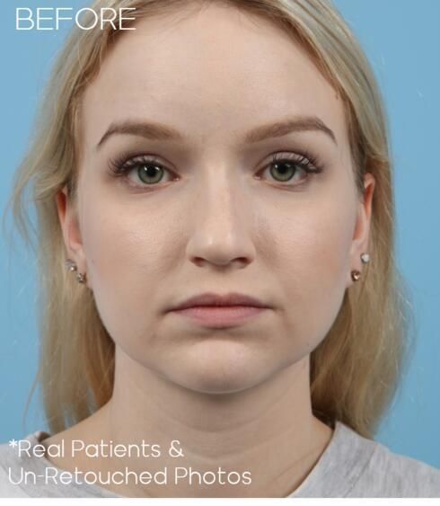 Rhinoplasty Before & After