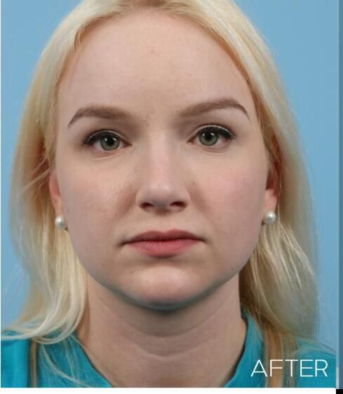 Rhinoplasty Before & After