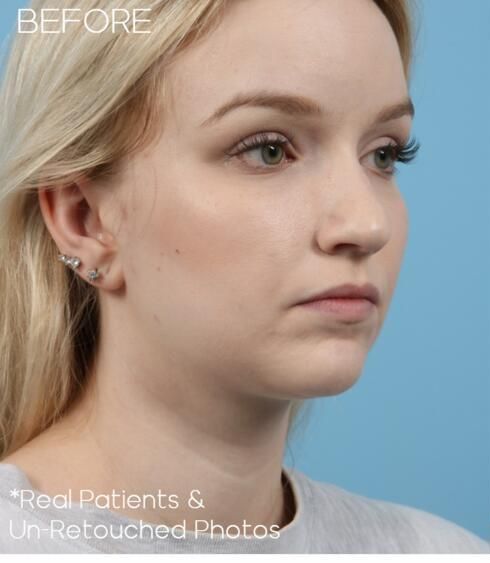 Rhinoplasty Before & After