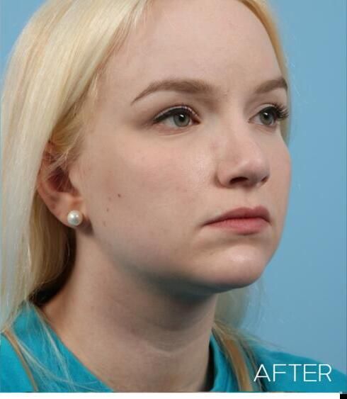 Rhinoplasty Before & After