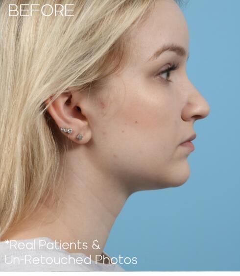Rhinoplasty Before & After