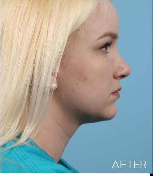 Rhinoplasty Before & After