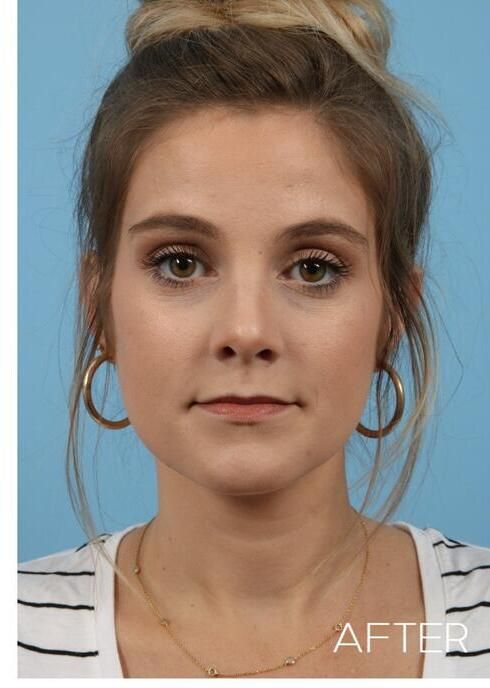 Rhinoplasty Before & After