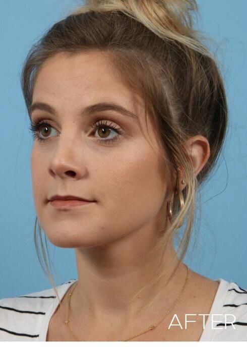 Rhinoplasty Before & After