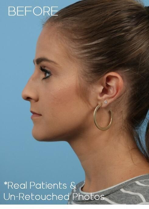 Rhinoplasty Before & After