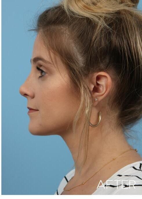 Rhinoplasty Before & After