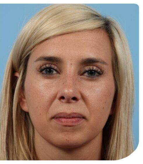 Rhinoplasty Before & After