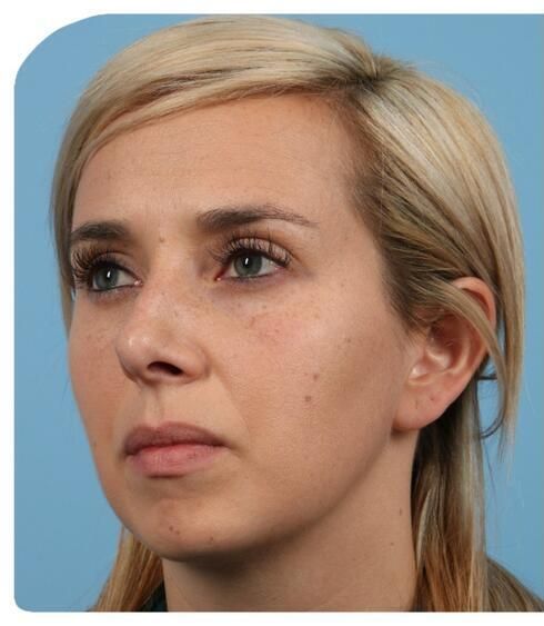 Rhinoplasty Before & After