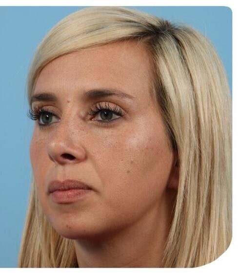 Rhinoplasty Before & After