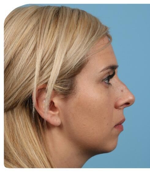 Rhinoplasty Before & After