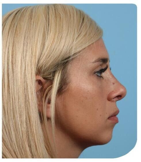 Rhinoplasty Before & After