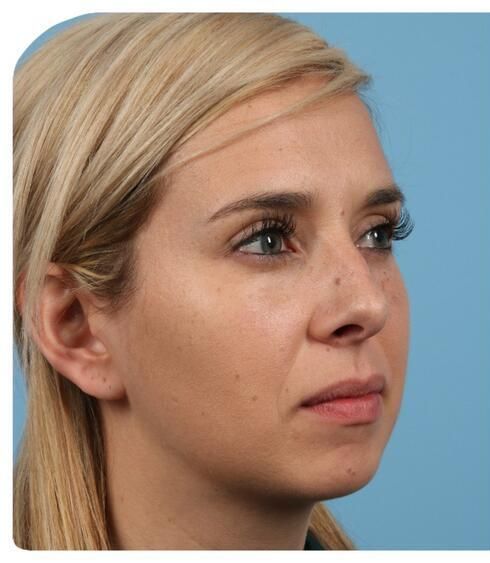 Rhinoplasty Before & After