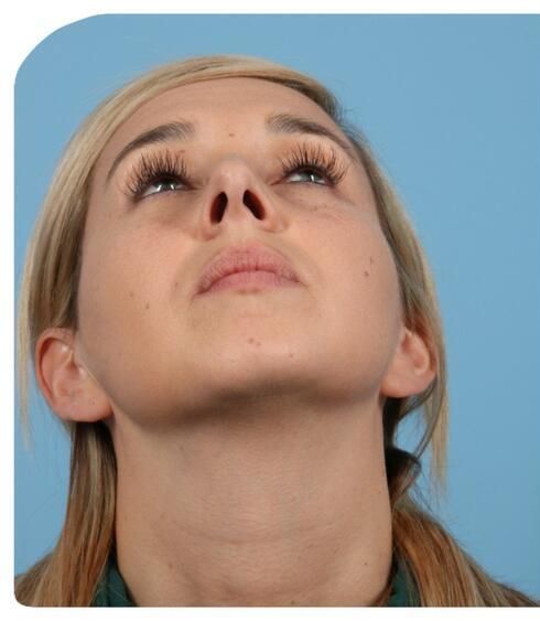 Rhinoplasty Before & After