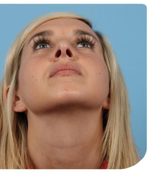 Rhinoplasty Before & After