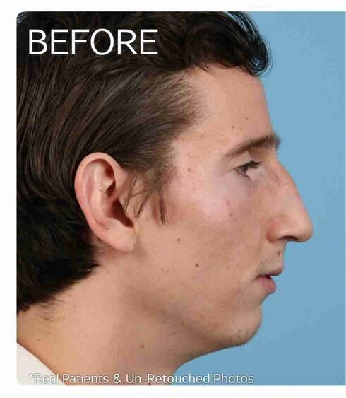 Rhinoplasty Before & After