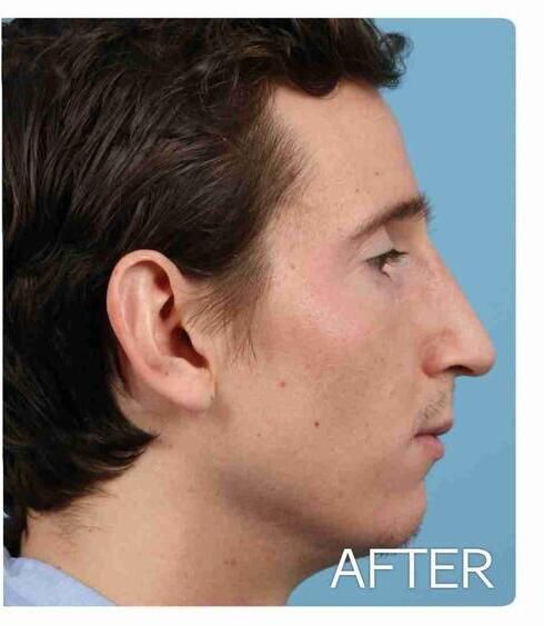 Rhinoplasty Before & After