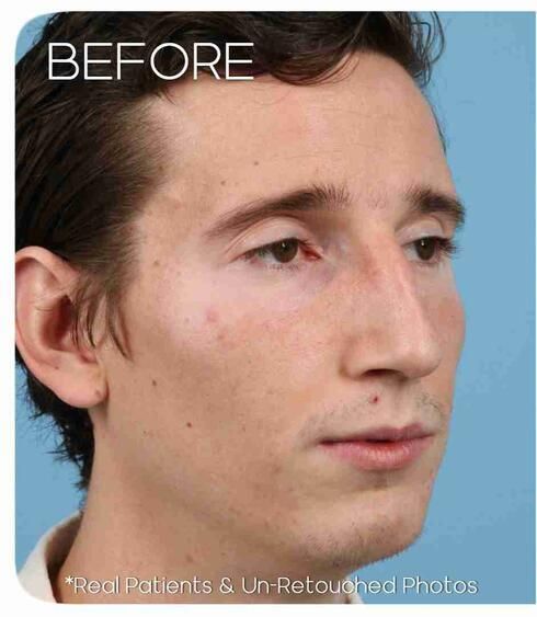 Rhinoplasty Before & After